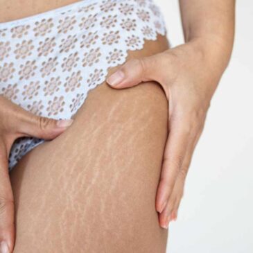 Aplicación de CO₂, Perfect Beauty®